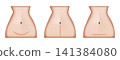 Woman body showing different types of cesarean section scars 141384080