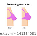 Breast augmentation showing before and after comparison 141384081
