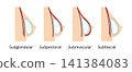 Breast implants showing different placement types during augmentation surgery 141384083