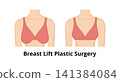 Breast lift plastic surgery procedure comparing results 141384084