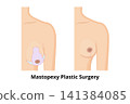 Mastopexy mastoplasty breast lift plastic surgery diagram 141384085