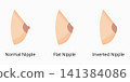 Different nipple types illustrating normal, flat, and inverted anatomy 141384086