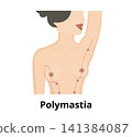 Polymastia condition medical illustration showing accessory breast tissue 141384087