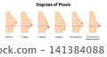 Degrees of breast ptosis grading scale illustration 141384088