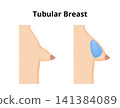 Understanding tubular breast comparing normal breast anatomy 141384089