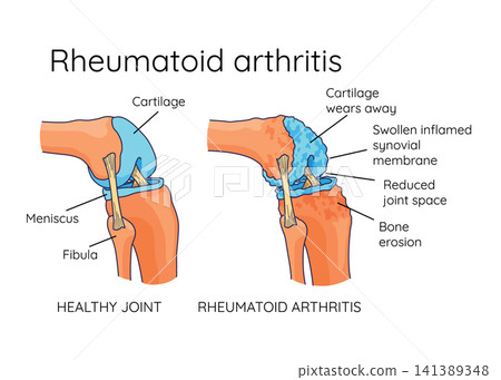Rheumatoid arthritis. A comparison between a healthy knee and joint with Bone erosion, Cartilage wears, Reduced joint space and Swollen inflamed synovial membrane. Vector illustration Rheumatoid arthritis. A comparison between a healthy knee and joint with Bone erosion, Cartilage wears, Reduced joint space and Swollen inflamed synovial membrane. Vector illustration 141389348