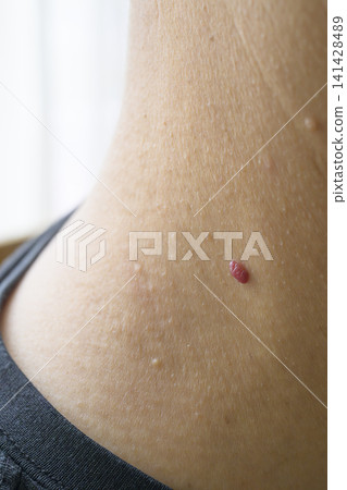 Warts on the neck Warts on the neck 141428489