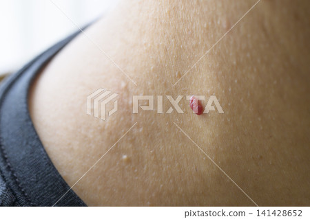 Warts on the neck 141428652