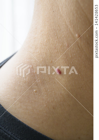 Warts on the neck Warts on the neck 141428653