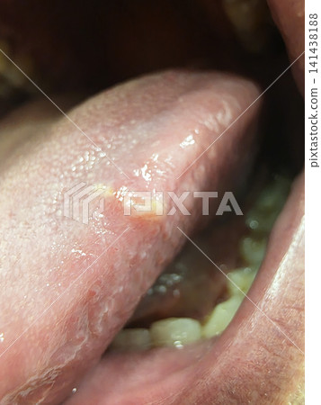 Close up view of human tongue surface showing oral lesion possibly canker sore or ulcer condition detail of common medical issue inflammation tissue Close up view of human tongue surface showing oral lesion possibly canker sore or ulcer condition detail of common medical issue inflammation tissue 141438188