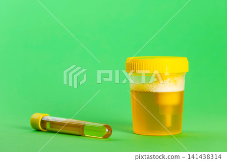 A test tube with reagent and urine on a green background. Bacterial culture for Enterobacteriaceae and Staphylococcus saprophyticus bacteria, which cause pain and inflammation in the urinary tract. A test tube with reagent and urine on a green background. Bacterial culture for Enterobacteriaceae and Staphylococcus saprophyticus bacteria, which cause pain and inflammation in the urinary tract. 141438314