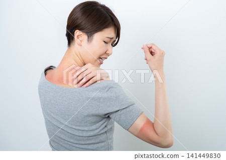 A woman with a red sunburn 141449830