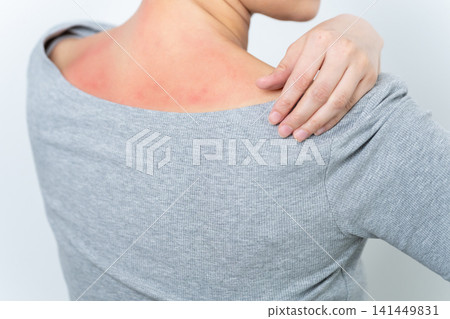 一位曬傷嚴重的女性 一位曬傷嚴重的女性 141449831