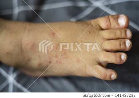Red Rash On Toddler Foot From Hand Foot Mouth Disease Red Rash On Toddler Foot From Hand Foot Mouth Disease 141455282
