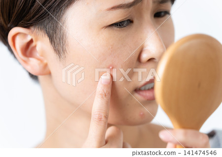 A woman suffering from facial acne A woman suffering from facial acne 141474546