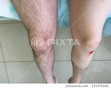 A close-up of a man's bare legs. One leg has been shaved in preparation for surgery. There is a small, bleeding wound on his shin A close-up of a man's bare legs. One leg has been shaved in preparation for surgery. There is a small, bleeding wound on his shin 141476168