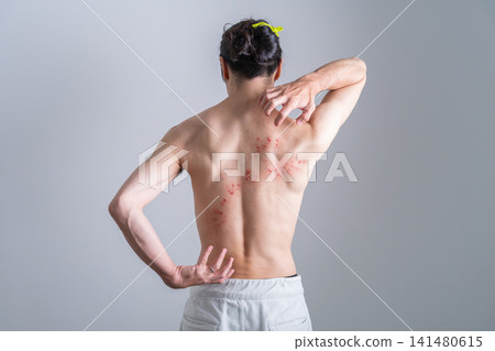 背部長滿皮疹的男人-特效化妝 背部長滿皮疹的男人-特效化妝 141480615
