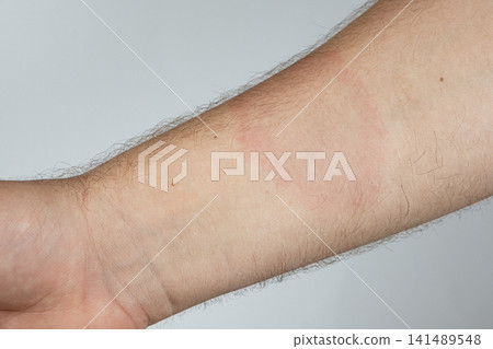 Medical symptom of Lyme disease with characteristic red ring rash on human body 141489548
