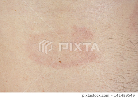 Erythema migrans rash on human skin caused by Lyme disease from a tick bite Erythema migrans rash on human skin caused by Lyme disease from a tick bite 141489549