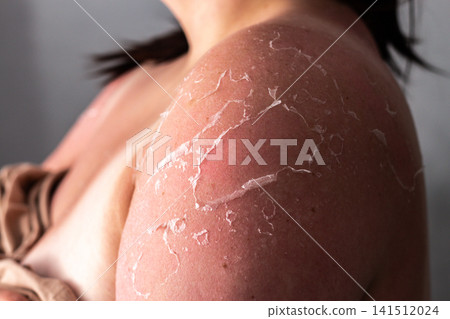 Woman with peeling skin on shoulders after sunburn. Red irritated patches from UV overexposure. Reminder to apply SPF cream and avoid peak sun hours for safety Woman with peeling skin on shoulders after sunburn. Red irritated patches from UV overexposure. Reminder to apply SPF cream and avoid peak sun hours for safety 141512024