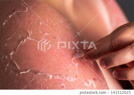 Woman removing old peeling skin after sunburn. UV damage and unprotected tanning consequences visible. Burn recovery process Woman removing old peeling skin after sunburn. UV damage and unprotected tanning consequences visible. Burn recovery process 141512025