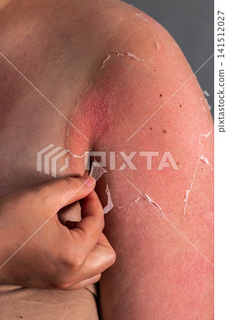 Woman removing old peeling skin after sunburn. UV damage and unprotected tanning consequences visible. Burn recovery process Woman removing old peeling skin after sunburn. UV damage and unprotected tanning consequences visible. Burn recovery process 141512027