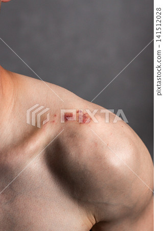 Close up of male shoulder with red bruise on it. Small wound caused by impact. Damaged skin on human body 141512028