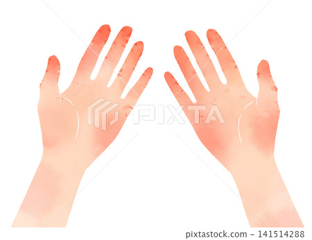 Watercolor-style illustration of chapped palms; depicting skin symptoms such as cracking and chilblains. Watercolor-style illustration of chapped palms; depicting skin symptoms such as cracking and chilblains. 141514288