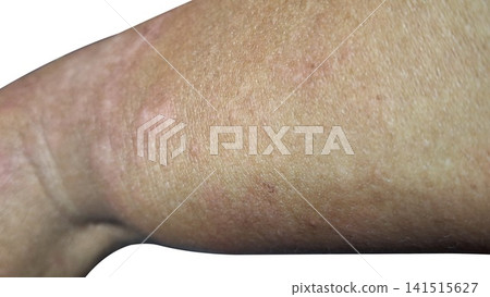 Sunburned human skin texture closeup on arm for medical dermatology and healthcare concepts. Sunburned human skin texture closeup on arm for medical dermatology and healthcare concepts. 141515627