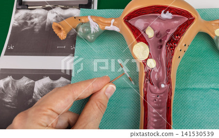 Copper intrauterine device in doctor's hand with uterus model background. Modern safe gynecological contraception Copper intrauterine device in doctor's hand with uterus model background. Modern safe gynecological contraception 141530539