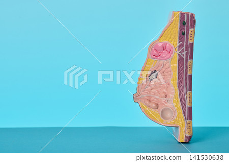 Female breast cancer anatomical model close-up. Pathology of malignant tumors for oncology check-up. 141530638