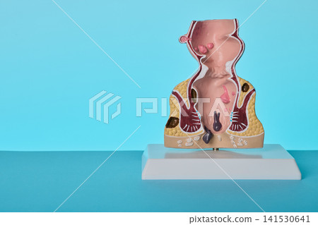 Rectum anatomical model on doctor desk in proctology clinic. Diagnostics of painful hemorrhoids and anal fissure. Rectum anatomical model on doctor desk in proctology clinic. Diagnostics of painful hemorrhoids and anal fissure. 141530641