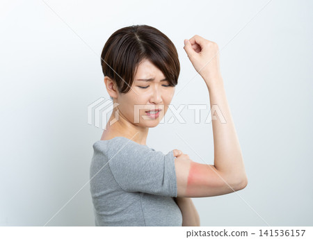 A woman with red, sunburned arms A woman with red, sunburned arms 141536157