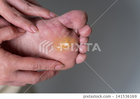 Corns on the soles of the feet (special effects makeup) Corns on the soles of the feet (special effects makeup) 141536169