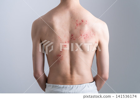 背部長滿皮疹的男人-特效化妝 背部長滿皮疹的男人-特效化妝 141536174