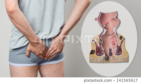 Medical collage of man holding his lower buttocks in pain and detailed anatomical model of rectum with hemorrhoids. Proctology diagnostic consultation and hemorrhoid treatment. Medical collage of man holding his lower buttocks in pain and detailed anatomical model of rectum with hemorrhoids. Proctology diagnostic consultation and hemorrhoid treatment. 141565617