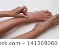 Woman's hands gently removing dead skin from sun-damaged legs, showcasing post-sunburn care and dermatological healing in high detail. 141569060