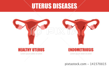 Uterus diseases. Endometriosis concept. Medical check up. Vector illustration in flat style Uterus diseases. Endometriosis concept. Medical check up. Vector illustration in flat style 141570815