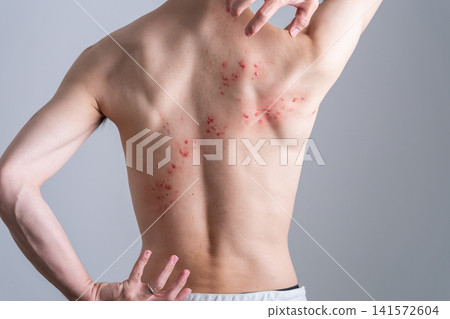 A man with a rash on his back - special effects makeup A man with a rash on his back - special effects makeup 141572604