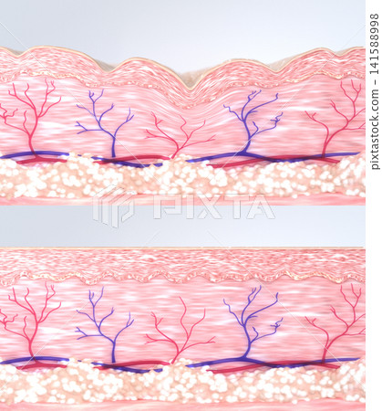 Medical 3D illustration of cross-section of human skin tissue before and after anti-aging wrinkle reduction beauty treatment. Simile of young and aging skin fibers 141588998