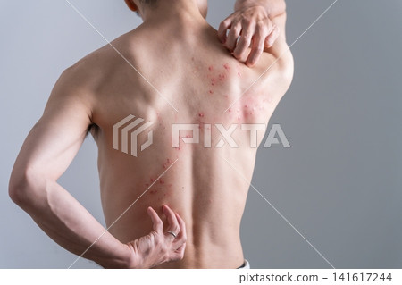背部長滿皮疹的男人-特效化妝 背部長滿皮疹的男人-特效化妝 141617244