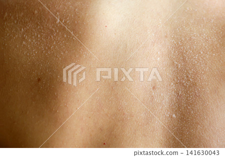 A close-up view of dry, peeling skin on a person woman back, illustrating dermatology, skin dehydration, peeling after sunburn, and health care A close-up view of dry, peeling skin on a person woman back, illustrating dermatology, skin dehydration, peeling after sunburn, and health care 141630043