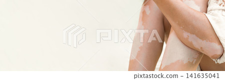 Close up of female legs and arms with vitiligo, unique pigmentation, autoimmune skin condition, copy space Close up of female legs and arms with vitiligo, unique pigmentation, autoimmune skin condition, copy space 141635041