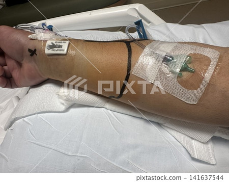 導管治療後手腕腫脹和血腫;術後恢復期間橈動脈穿刺部位。 導管治療後手腕腫脹和血腫;術後恢復期間橈動脈穿刺部位。 141637544