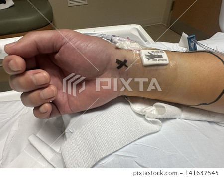 Wrist showing internal bleeding and swelling after catheter treatment: Postoperative recovery progress Wrist showing internal bleeding and swelling after catheter treatment: Postoperative recovery progress 141637545