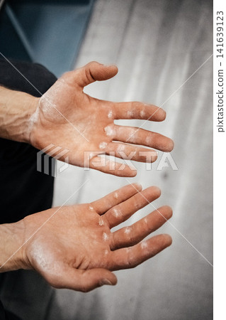 Chalk Covered Male Climber Hands After Hard Route: Close Up Of Worn Fingers And Taped Skin Chalk Covered Male Climber Hands After Hard Route: Close Up Of Worn Fingers And Taped Skin 141639123