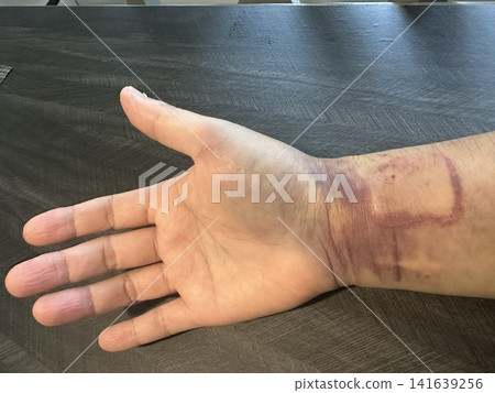 Internal bleeding spreading from the wrist to the forearm; subcutaneous bleeding after catheter examination/treatment. Internal bleeding spreading from the wrist to the forearm; subcutaneous bleeding after catheter examination/treatment. 141639256