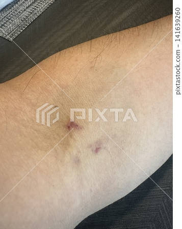 Puncture marks and mild bruising after blood draw; marks on the arm from repeated blood draws. Puncture marks and mild bruising after blood draw; marks on the arm from repeated blood draws. 141639260