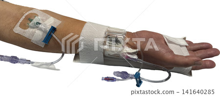 Patient's arm during catheter treatment (transparent PNG) IV line/medical procedure material Patient's arm during catheter treatment (transparent PNG) IV line/medical procedure material 141640285