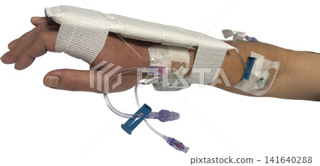 Intravenous drip route and fixation on the back of the hand during catheter treatment (transparent background PNG) Intravenous drip route and fixation on the back of the hand during catheter treatment (transparent background PNG) 141640288
